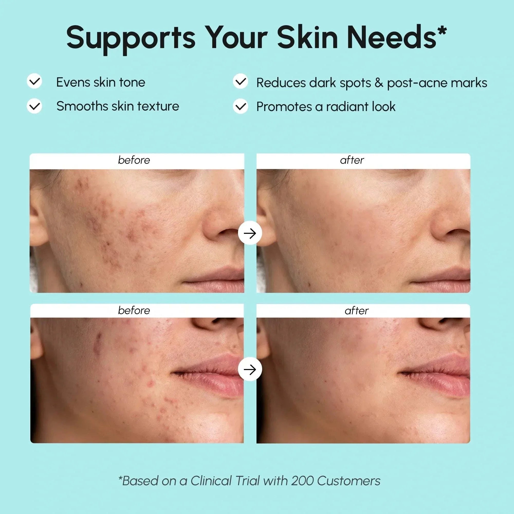 Azelaic Acid Cream benefits graphic showing before-and-after facial skin comparisons and claims about smoother texture and fewer dark spots