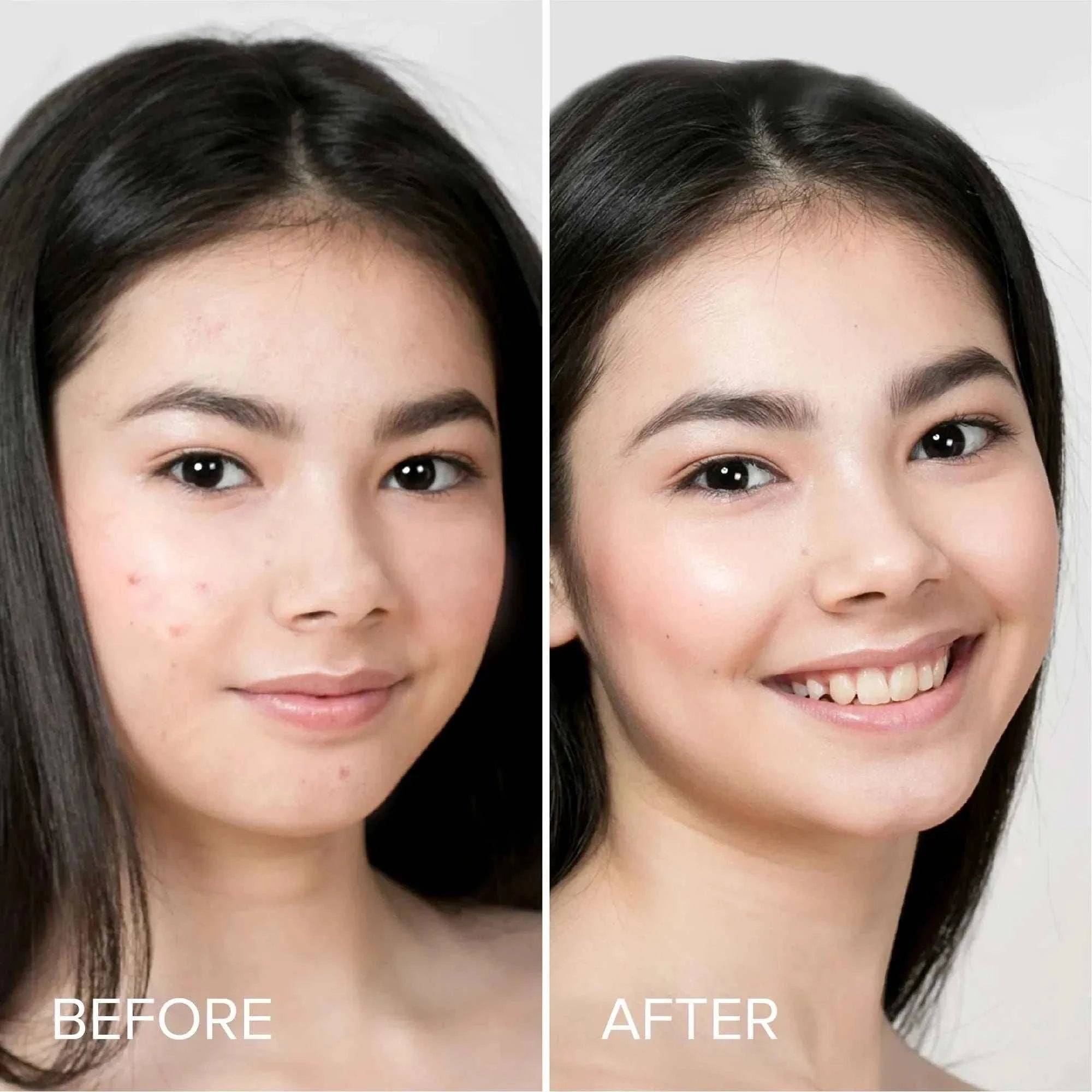 Cute star-shaped hydrocolloid pimple and acne patches for fast blemish treatment