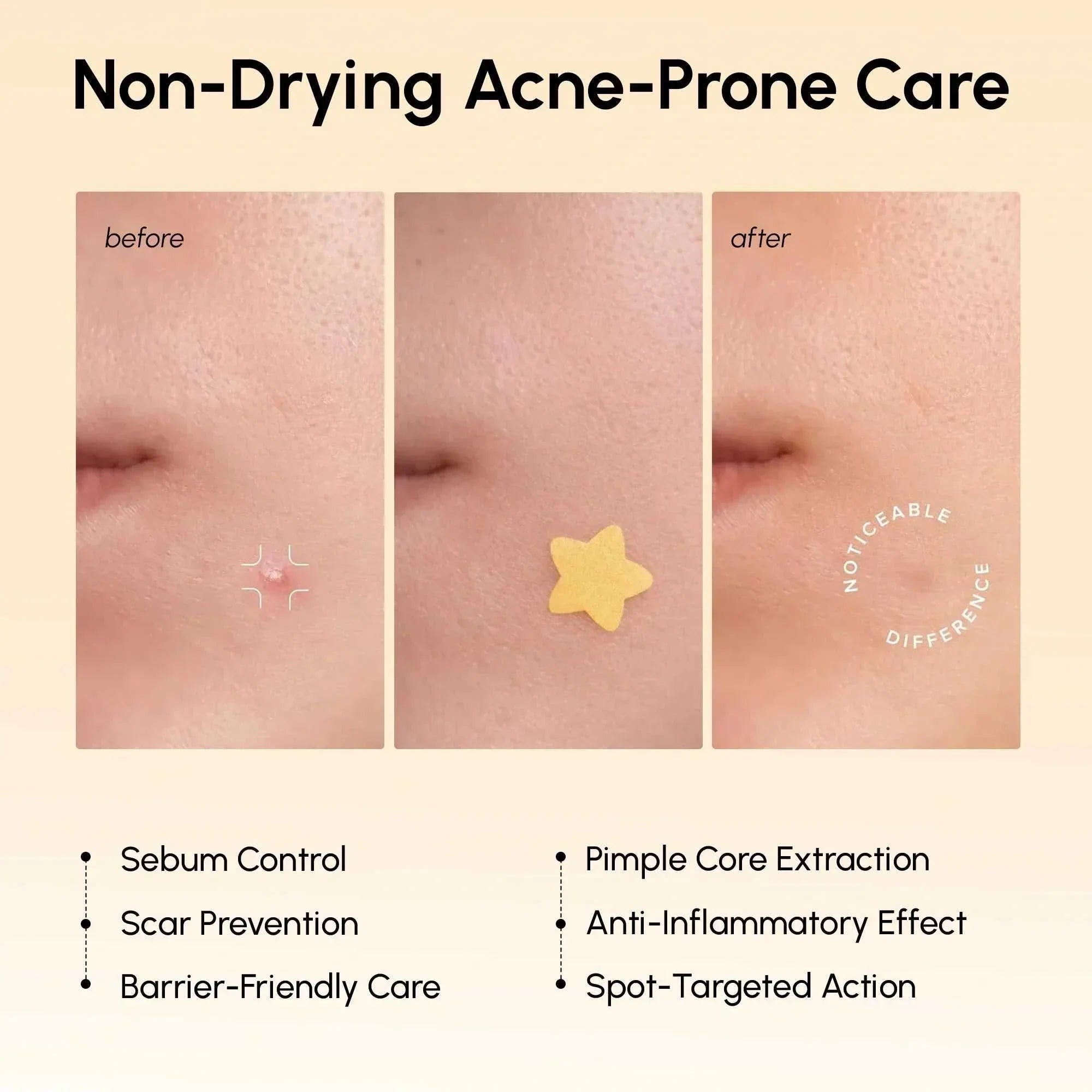 Gold Star Pimple acne patch, pale yellow star-shaped hydrocolloid sticker shown on skin for spot care.