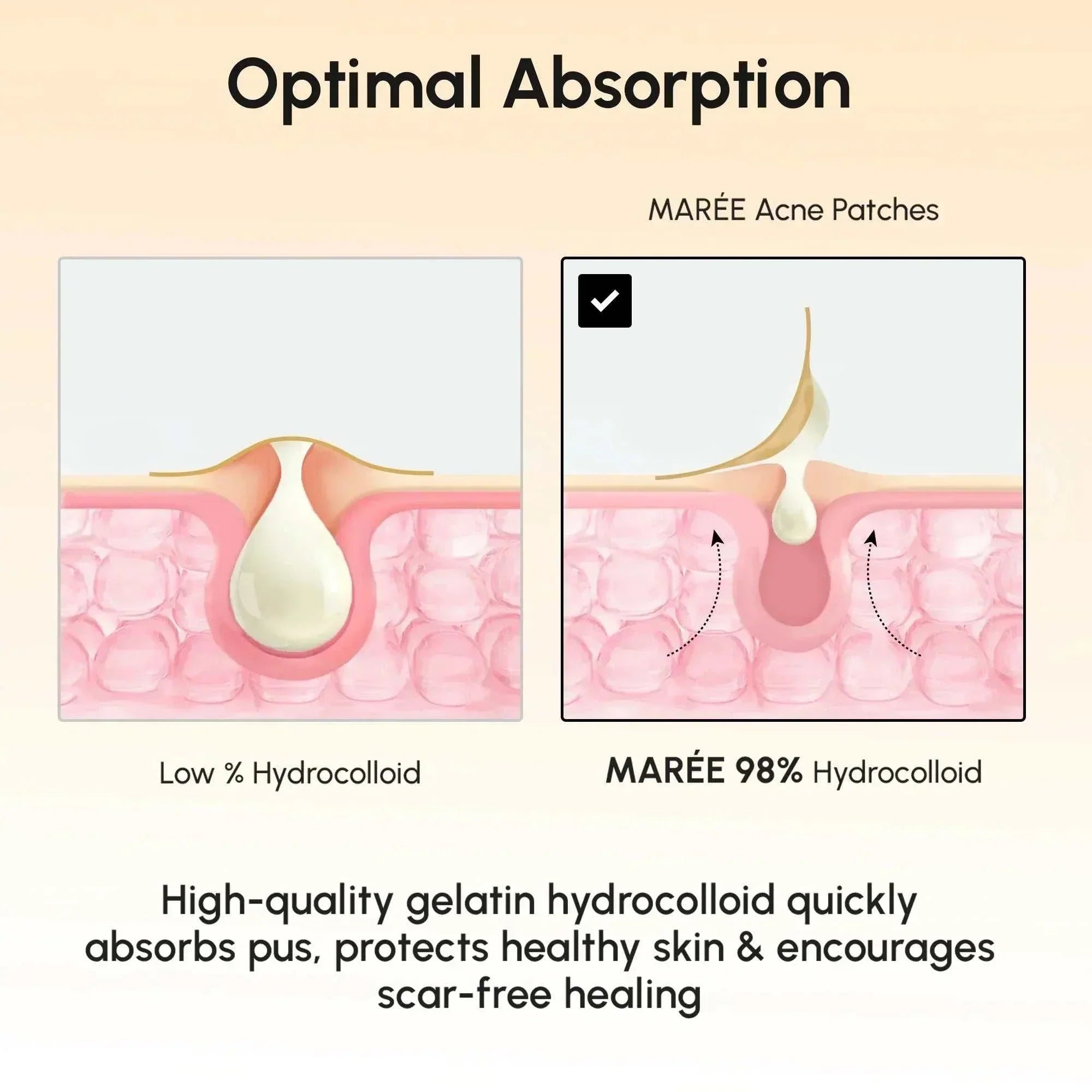 Gold Star Pimple hydrocolloid acne patches, shown in an absorption diagram comparing low and 98% hydrocolloid content.