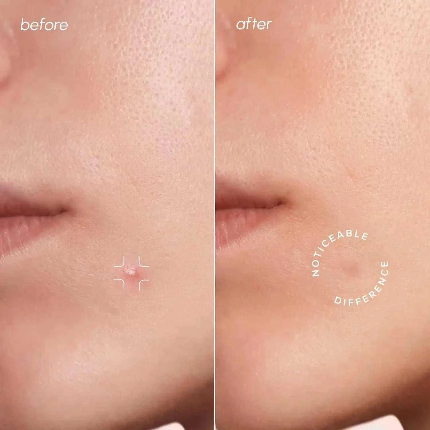 transparent invisible pimple and acne patch on skin