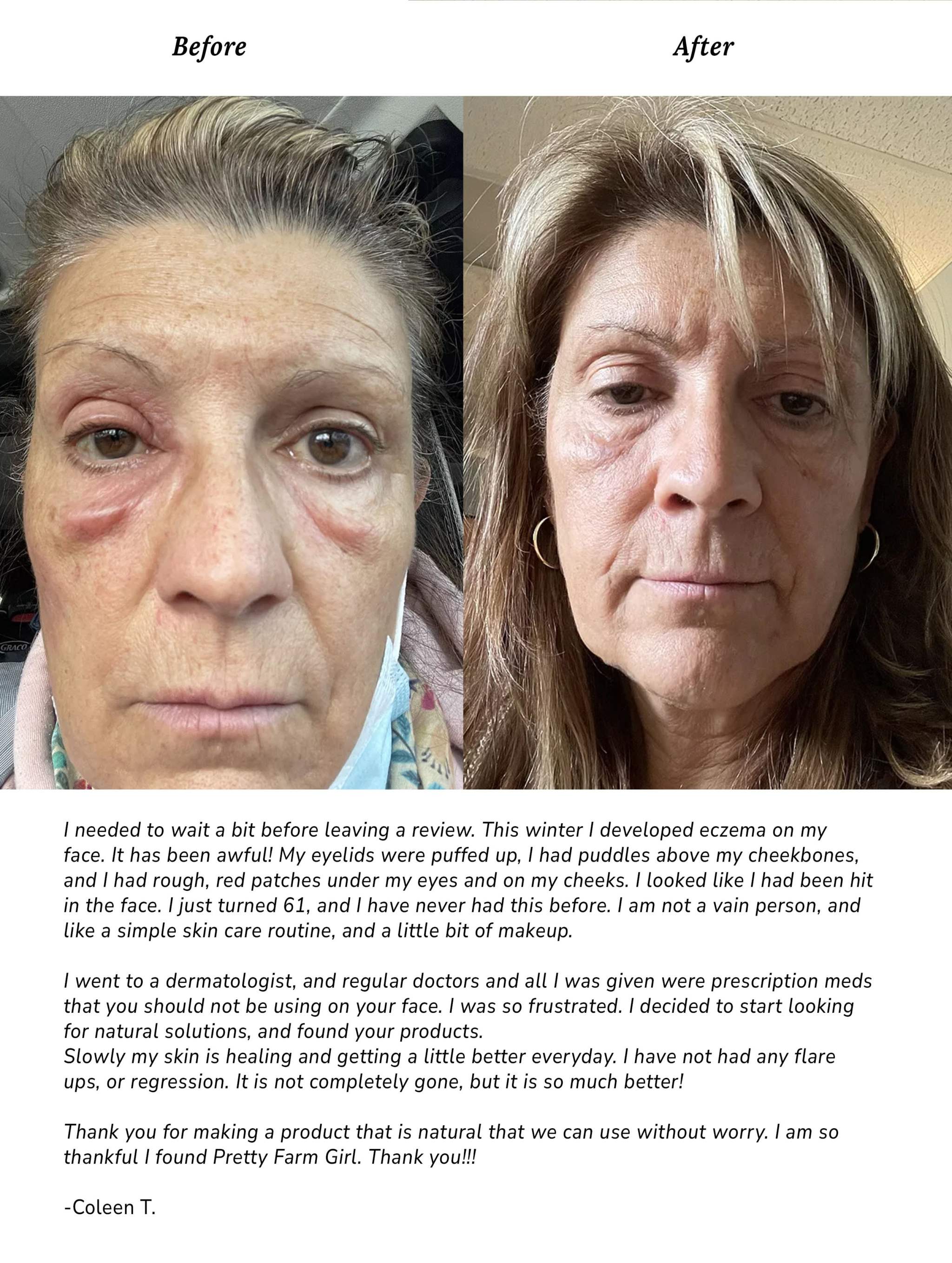 Pure + Simple Skin Kit testimonial showing before-and-after facial skin photos with visible redness and improved clarity