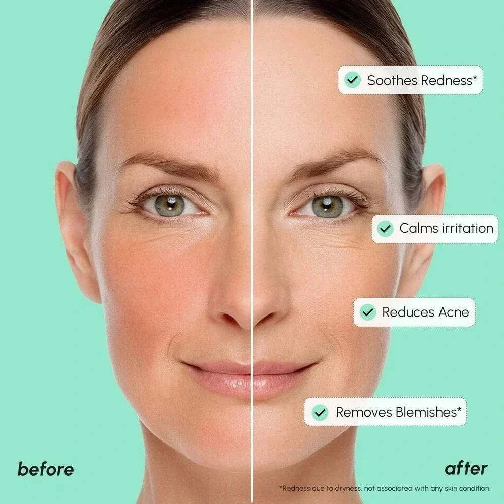 Redness soothing azelaic acid serum bottle for sensitive skin
